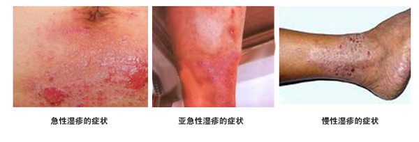 湿疹症状