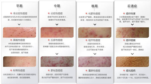 青春痘症状