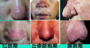 酒糟鼻症状
