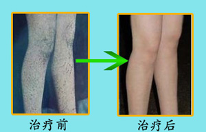 鱼鳞病