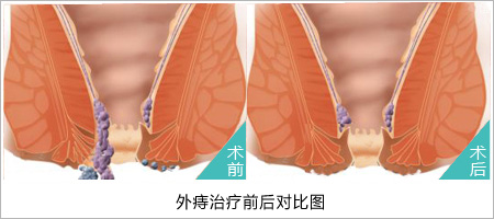 外痔治疗