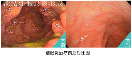 结肠炎