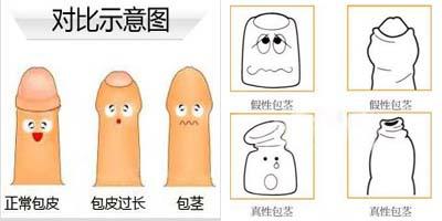 包皮包茎对比