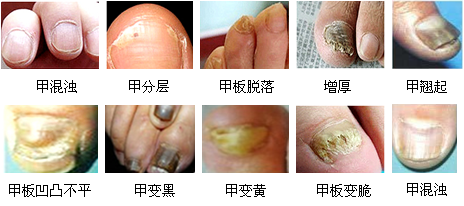 灰指甲