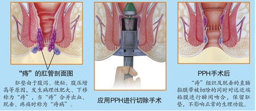 混合痔治疗