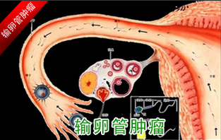 输卵管肿瘤