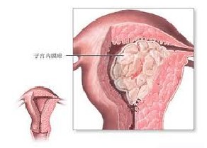 子宫内膜癌