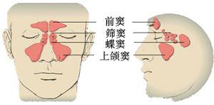 鼻窦炎