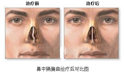 鼻中隔偏曲